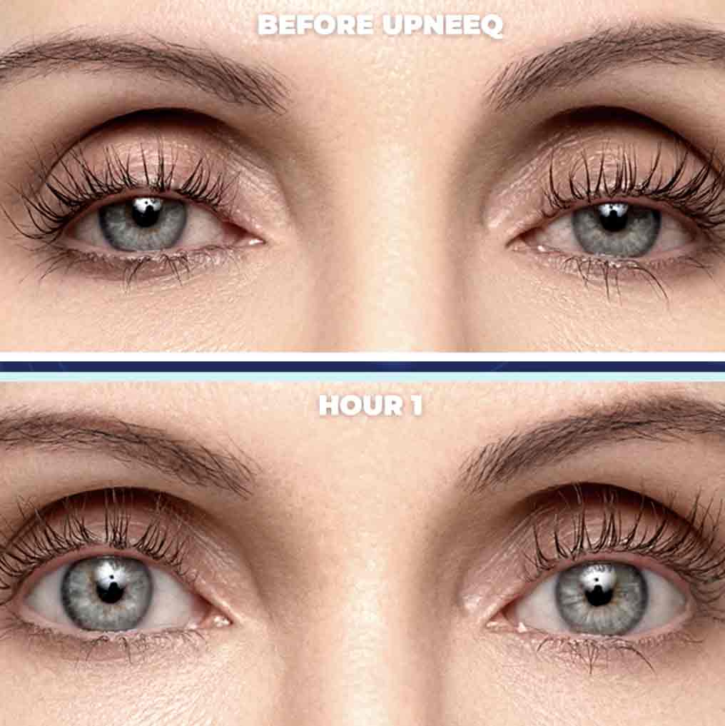 UPNEEQ Before and After Eye Photos